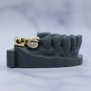 Custom yellow gold implant crown with a bezel-set oval diamond, fitted on the lower premolar position of a full dental arch model