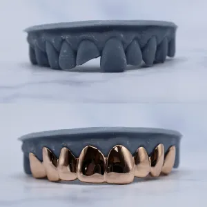 Custom rose gold solid bottom 8-tooth grillz fitted on a dental cast, shown before and after against a mold with broken lower teeth