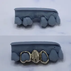 Custom white gold gap filler grillz with engraved initial on the center piece and open-face side caps, shown before and after on a dental cast with missing front teeth