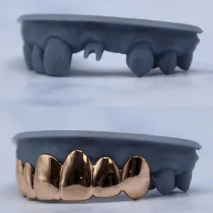 Custom rose gold solid bottom 6-tooth grillz covering missing lower teeth, shown before and after on a dental cast