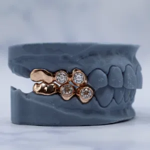 Custom rose gold permanent crowns shown in a closed bite position: two upper and two lower crowns each set with bezel-set round brilliant diamonds, shown on a dental cast
