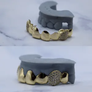 Custom top 8 yellow gold grillz with pavé diamond fang caps, shown before and after on a dental cast with missing upper teeth